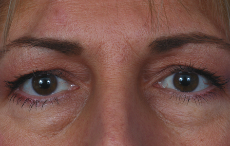 Upper Eyelid Surgery Before & After Photos