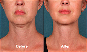 Kybella® Treatment Before & After