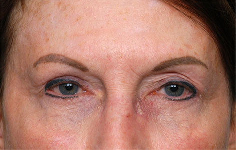 Lower Eyelid Surgery Before & After Photos