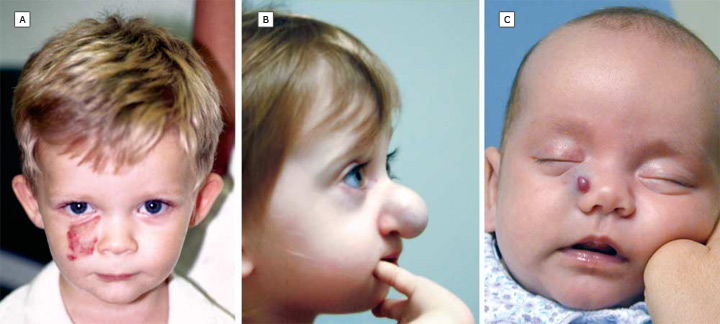 Facial Hemangiomas ABC