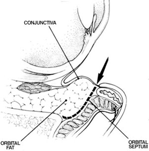 Rejuvenation of the Lower Eyelid Complex 5