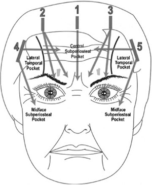 Illustration demonstrating the five standard endoscopic brow lift incisions