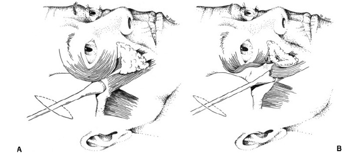 Illustrative drawing demonstrating the approach to the midface with the periosteal