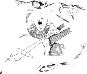 Illustrative drawing depicting suspension of midface with suture anchored from the malar fat pad to the temporalis fascia.