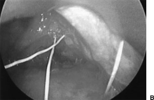 Intraoperative photograph obtained from endoscopic view 