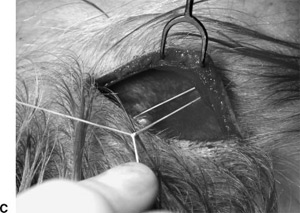 Intraoperative photograph of securing the suture after it is anchored to the temporalis fascia 