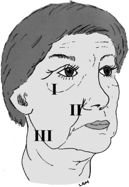 Depiction of facial zones I (malar/infraorbital complex), II (nasolabial sulcus), and III (jawline).