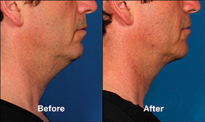 Candidate for Kybella® Treatment