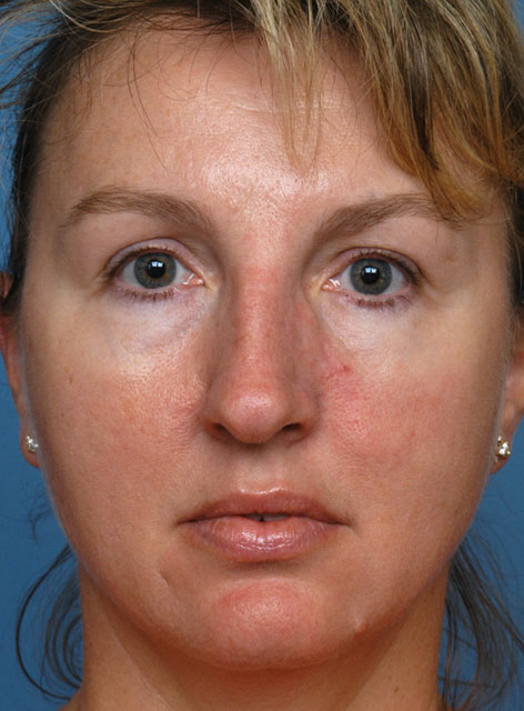 Skin Cancer Treatment Newport Beach patient front view after