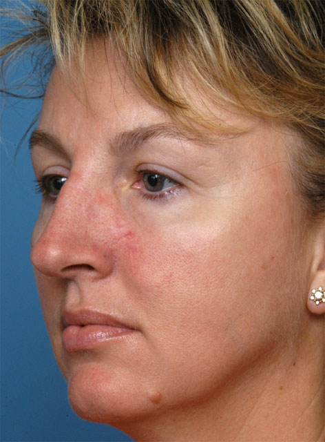 Skin Cancer Treatment Newport Beach patient oblique view after