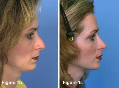 Tip Rhinoplasty 1B - 1C