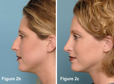 Tip Rhinoplasty 2B - 2C