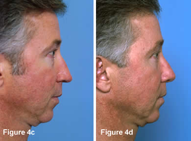 Tip Rhinoplasty 4C - 4D