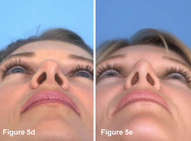 Tip Rhinoplasty 5D - 5E