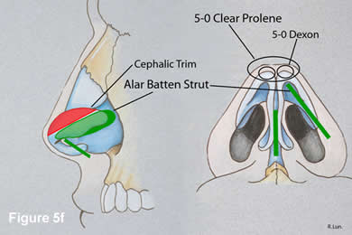 Tip Rhinoplasty 5F