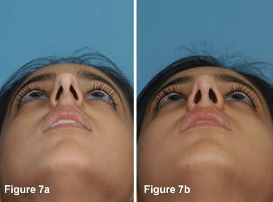 Tip Rhinoplasty 7A