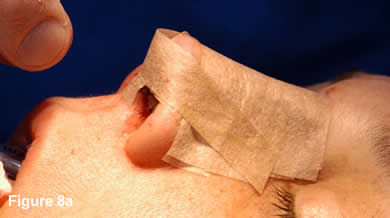 Tip Rhinoplasty 8A