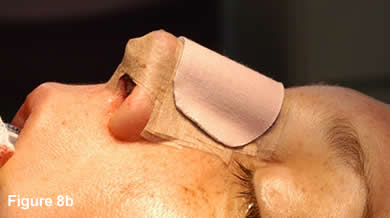 Tip Rhinoplasty 8B