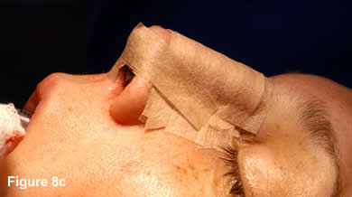 Tip Rhinoplasty 8C