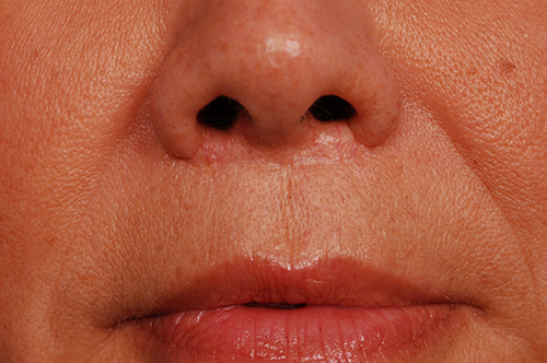 Lip Reshaping Before & After Photos