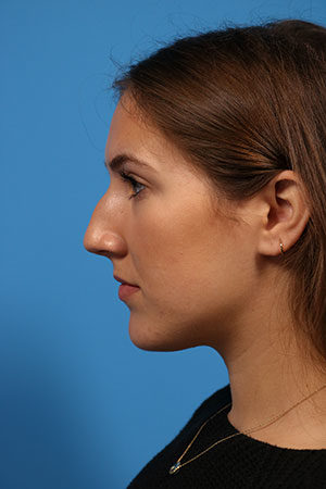 Newport Beach Rhinoplasty Before and After Photos - Orange County