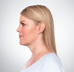 Kybella