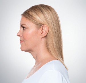 Kybella