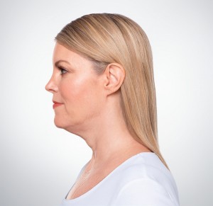 Kybella