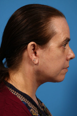 Rhinoplasty