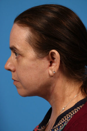 Rhinoplasty