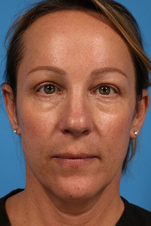 Upper Eyelid Surgery