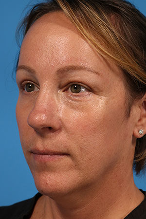 Upper Eyelid Surgery