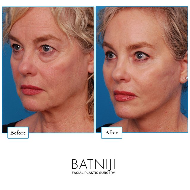 This 60 year old was treated with an endoscopic brow lift, upper & lower blepharoplasty, lower face & necklift to refine her jawline & neck