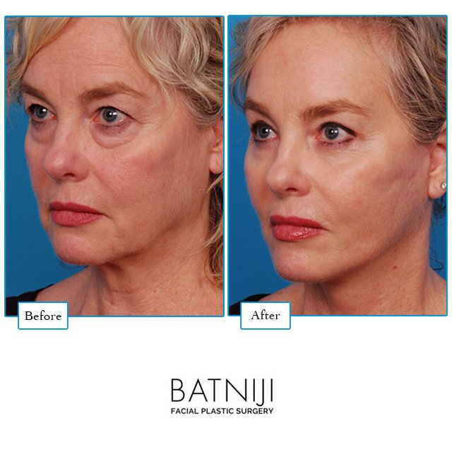 lower blepharoplasty before and after