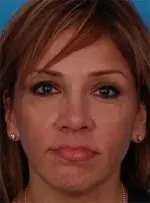 Lower blepharoplasty before