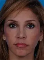 Lower blepharoplasty after