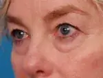 Lower blepharoplasty before