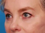 Lower blepharoplasty after