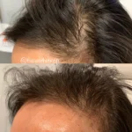 hair-restoration-ca-2-150x150