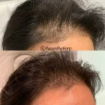hair-restoration-male-ca-2-150x150