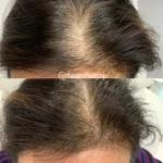 hair-restoration-newport-beach-150x150