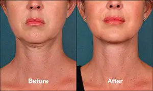 kybella-1