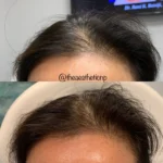 male-hair-restoration-hairline-2-150x150