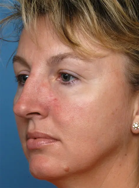 reconstructive-02-obl-left-after