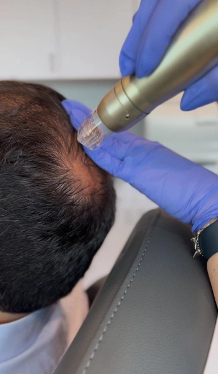 Hair Restoration side pic Hair Restoration side pic