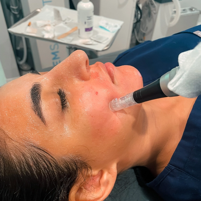 Microneedling 2 Microneedling 2