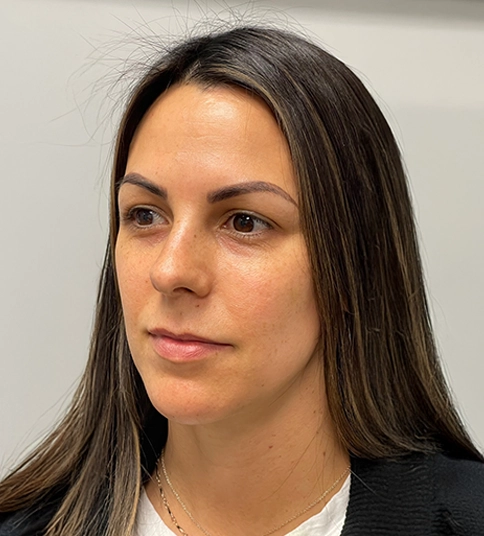 Woman with long hair after Botox in Newport Beach, standing in white shirt with neutral expression.
