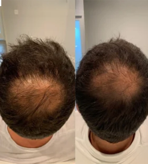 Before and after images showcasing the results of a hair transplant procedure, highlighting significant hair restoration.