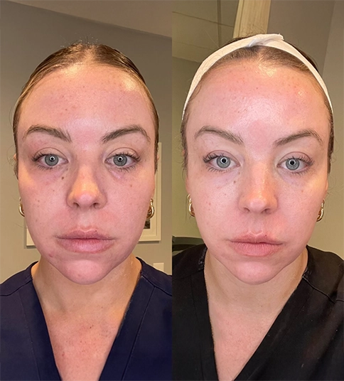 Woman before and after HydraFacial in Newport Beach, showing improved skin texture and radiant complexion.