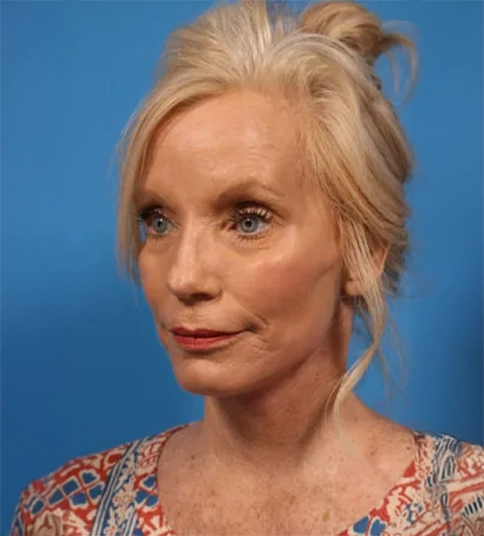 Patient after face lift procedure in Newport Beach showing smoother, youthful neckline.
